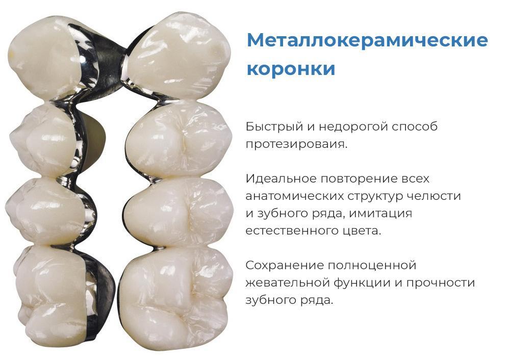Металлокерамика на зубы