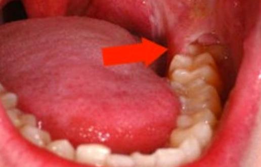 Альвеолит лунки зуба