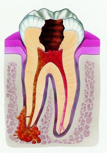 Лечение воспалительных заболеваний кости и челюстей в стомалогиии спб Dental House